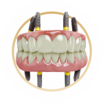 восстановление зубов всей челюсти под ключ в клинике ТоталСтом